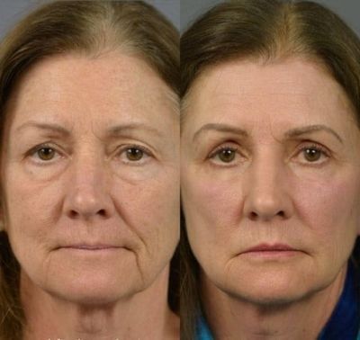 TheNestly+🔥 Instant face Tightener No-Filter Primer